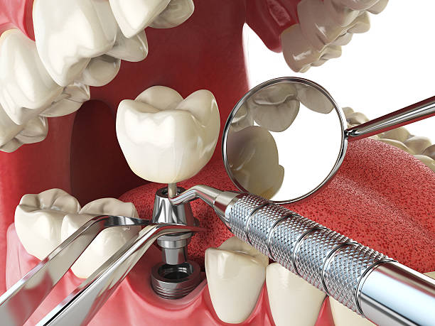 Best Emergency Wisdom Tooth Extraction in Springs, NY